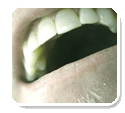 Chiropractic and Tourette's Syndrome