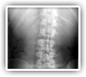 Improvement in Adolescent Idiopathic Scoliosis Following Chiropractic Care