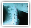 Reversed Neck Curve and Lower Back Pain Corrected with Chiropractic - A Case Study