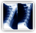 Cervical Disk Herniation Patients Helped with Chiropractic