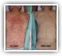 Resolution of Psoriasis with Chiropractic: A Case Report 