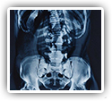 Spondylolistheses, Low Back Pain, and Urinary Function Helped by Chiropractic