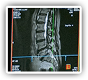 Subluxation Associated with a Wide Variety of Spinal Problems According to MRI Review Study